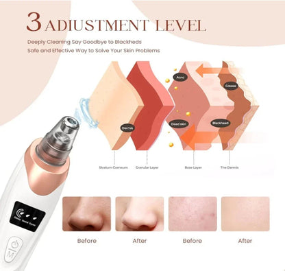 5 in 1 Blackhead Remover Vacuum Suction Device — Deep Pore Cleansing Acne Remover for All Skin Types