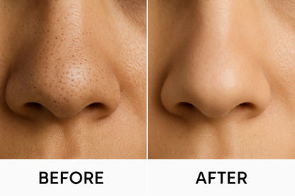 5 in 1 Blackhead Remover Vacuum Suction Device — Deep Pore Cleansing Acne Remover for All Skin Types